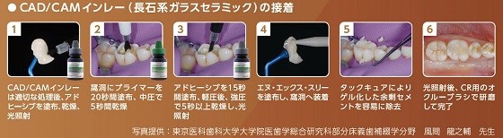 CAD/CAMインレーの接着