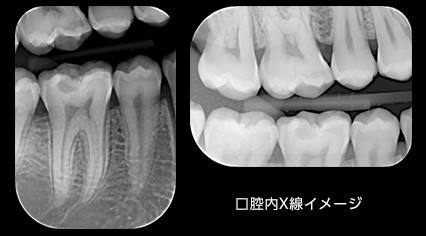 口腔内X線イメージ 口腔内X線イメージ