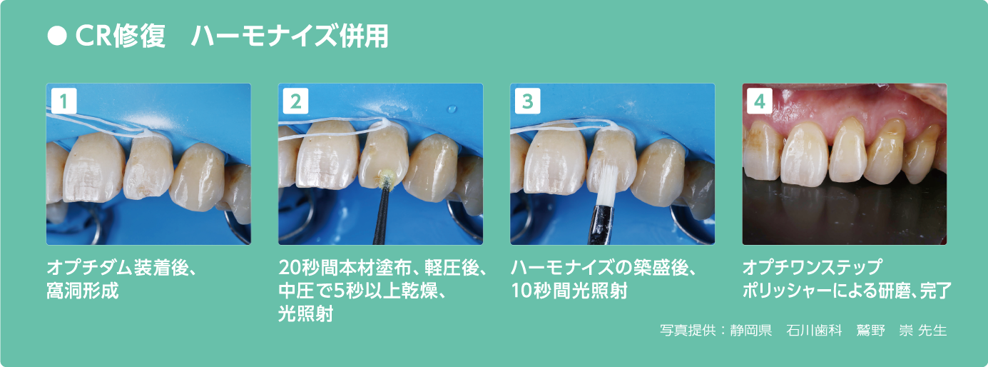 コンポジットレジン「ハーモナイズ」との併用