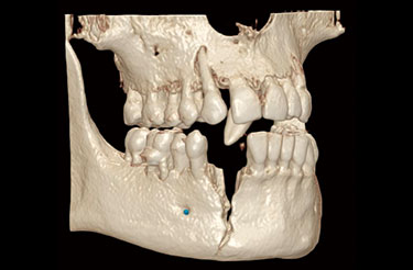 FOV Φ8 × H8cm